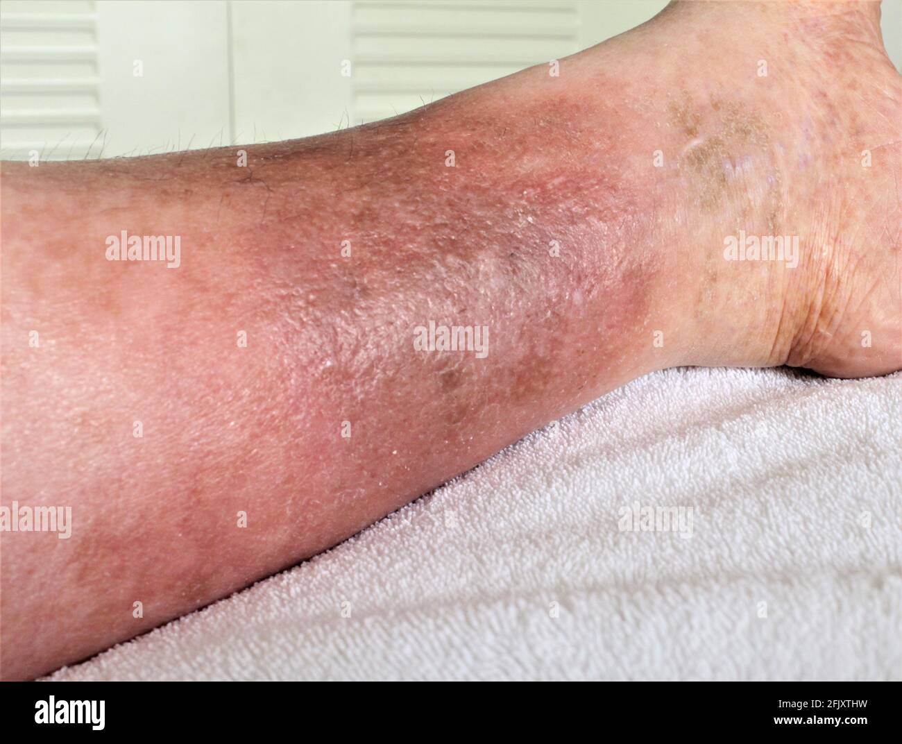 Woman's leg She's suffering from Chronic Venous Insufficiency with mild cellulitis. In bed as she rest to relieve heaviness swelling pain  redness leg Stock Photo