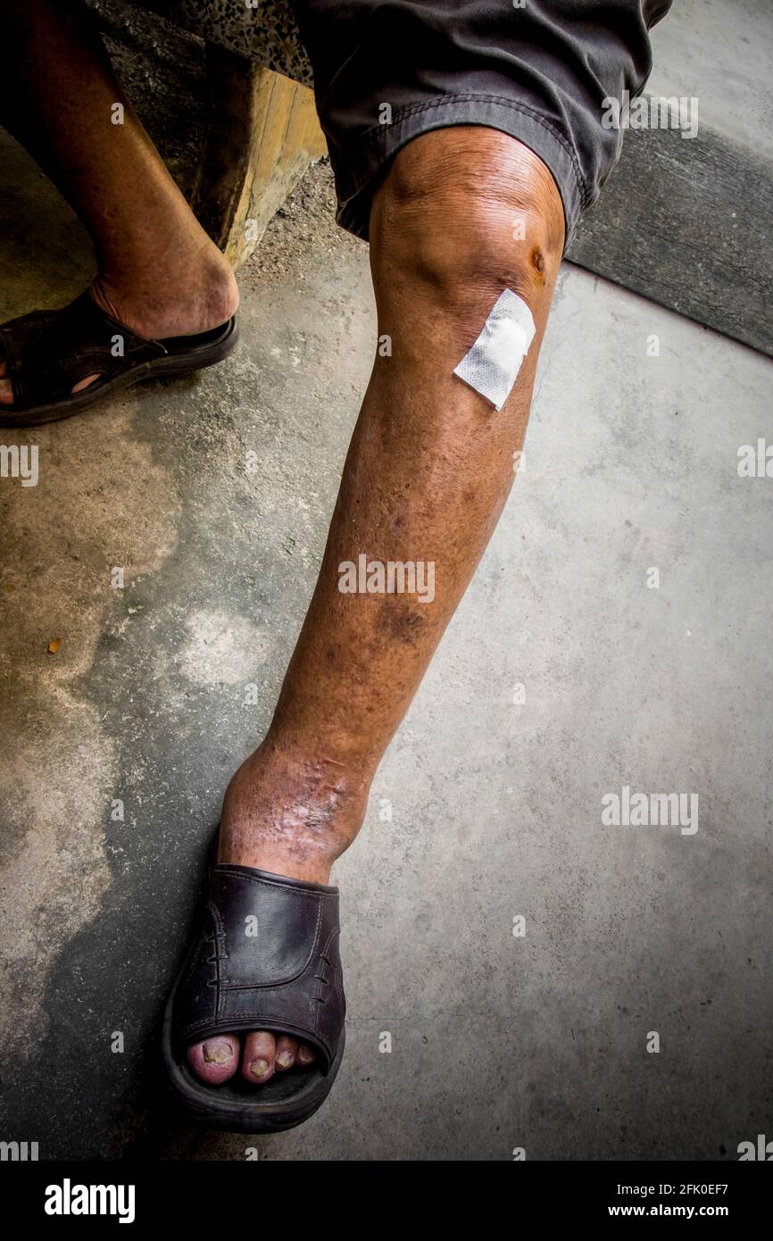 Swelling and leg ulcers in patients with kidney disease Stock Photo Alamy