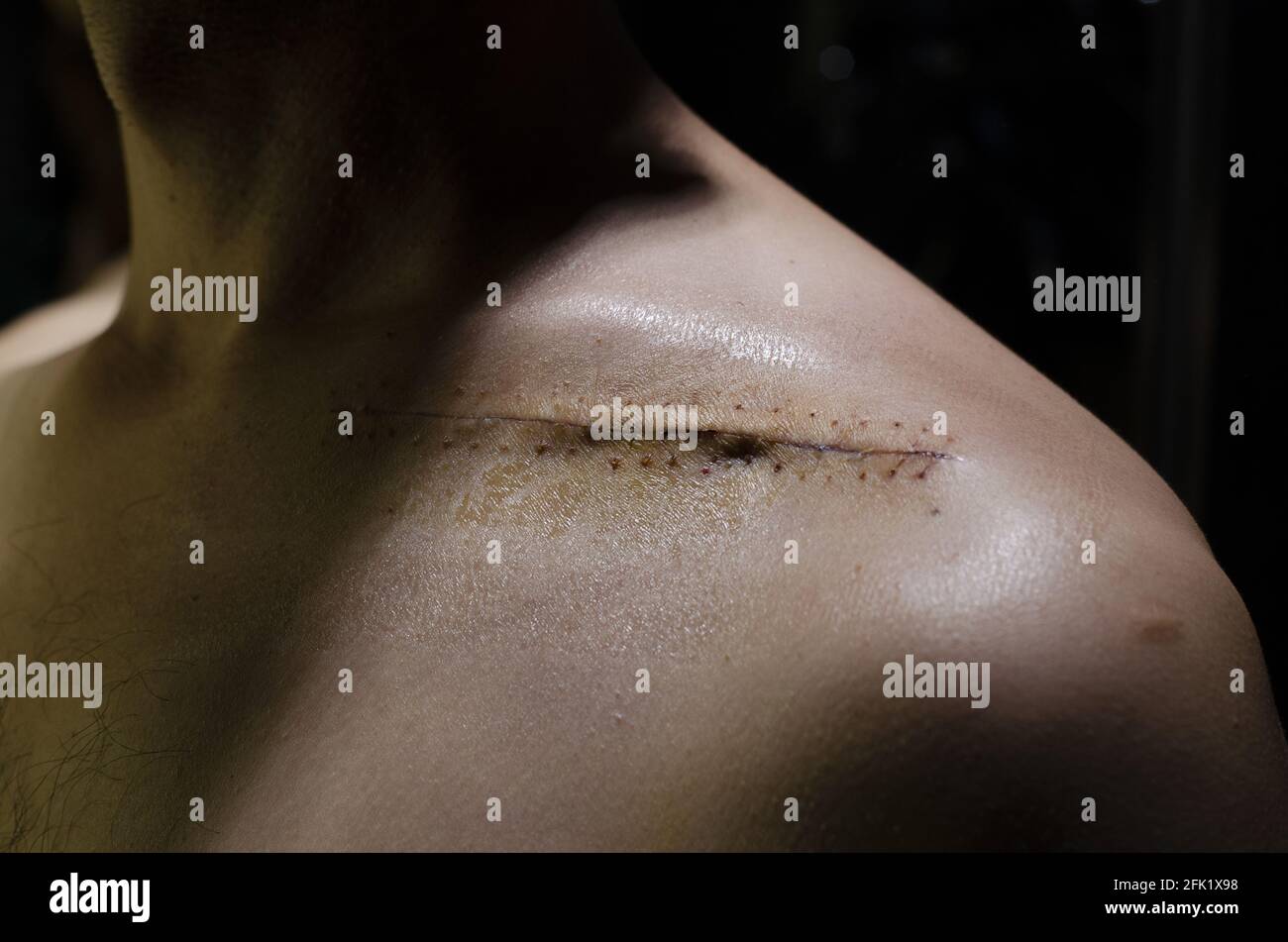 Closeup of stitches on man's collarbone isolated on black background Stock Photo