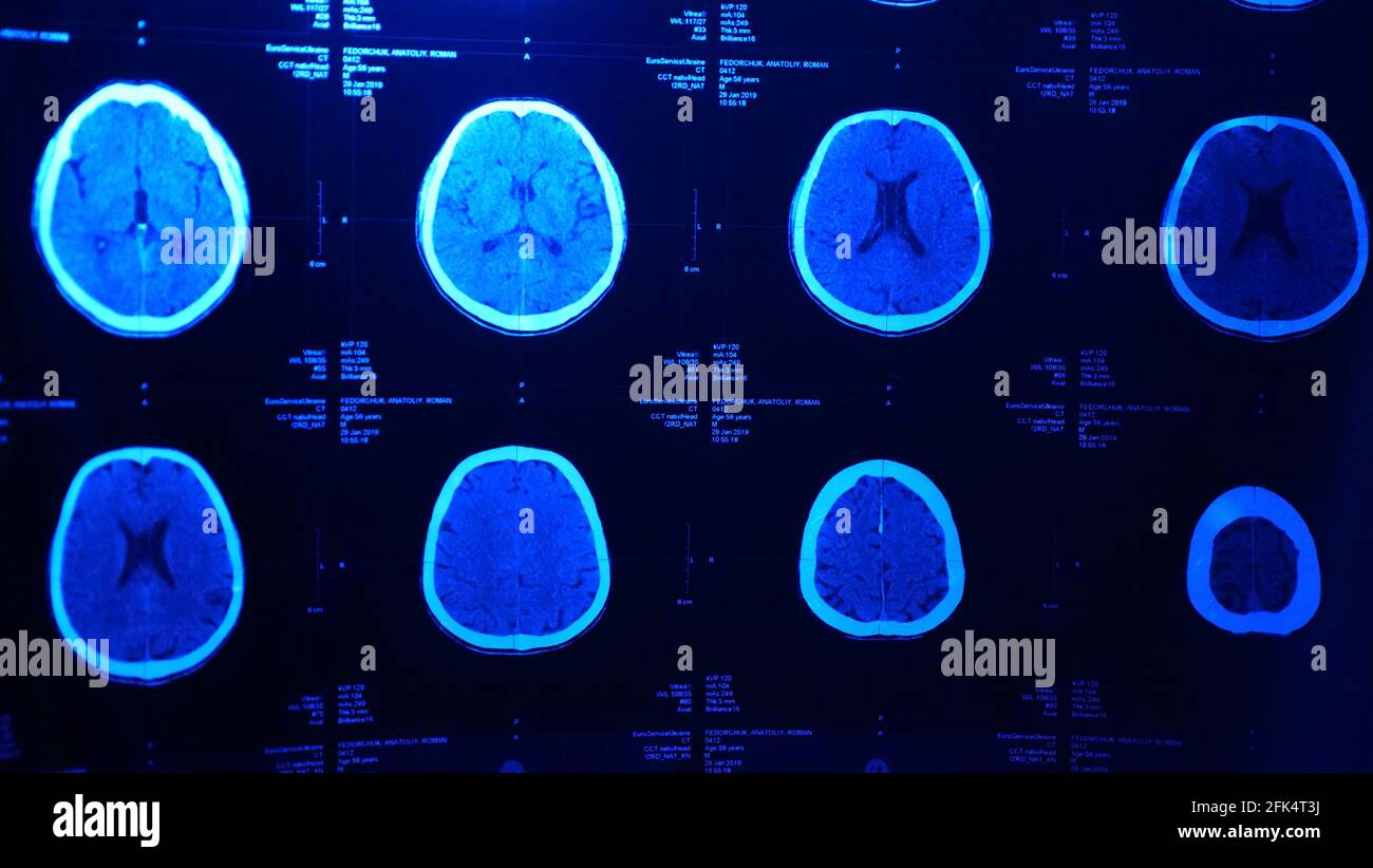 This stock photo shows a magnetic resonance imaging MRI of the brain after traumatic brain injury, showing that the brain is damaged with blue light Stock Photo