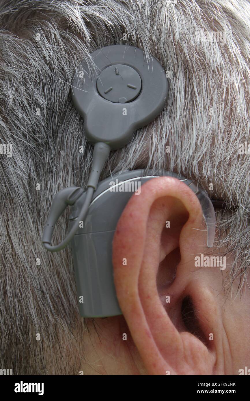 Cochlear Implants High Resolution Stock Photography and Images - Alamy