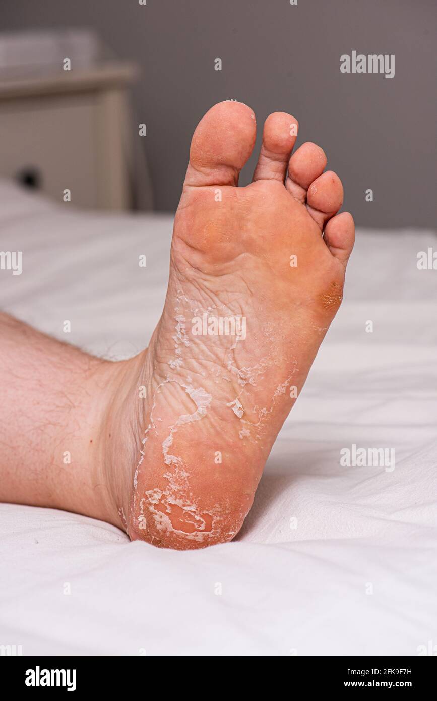 Skin peeling on the sole of a foot Stock Photo - Alamy