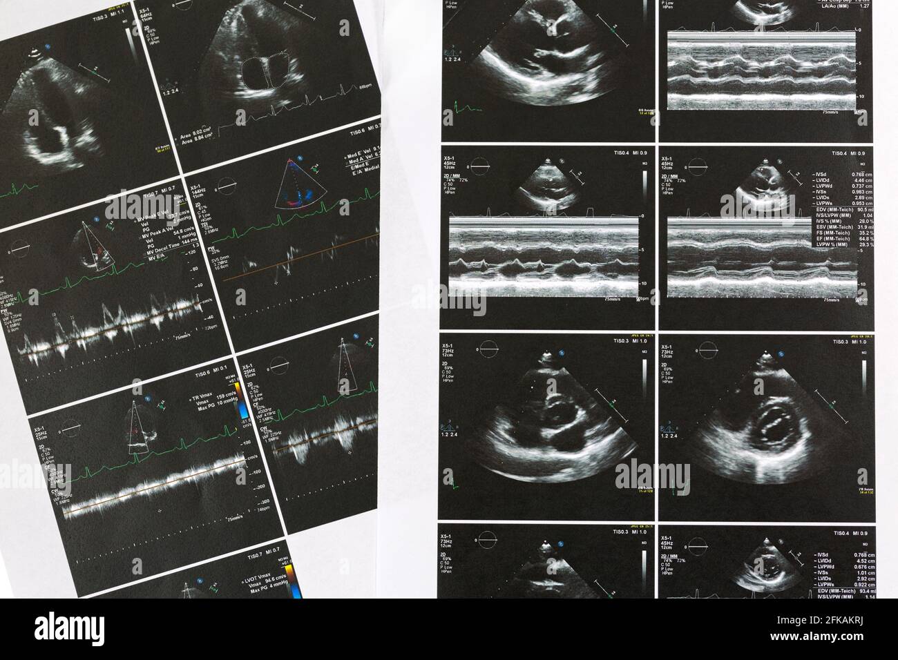 Printed set result paper of heart ultrasound scan examination. Echo cardiography examine for irregular heart beats, abnormal rhythm (arrhythmia) Stock Photo