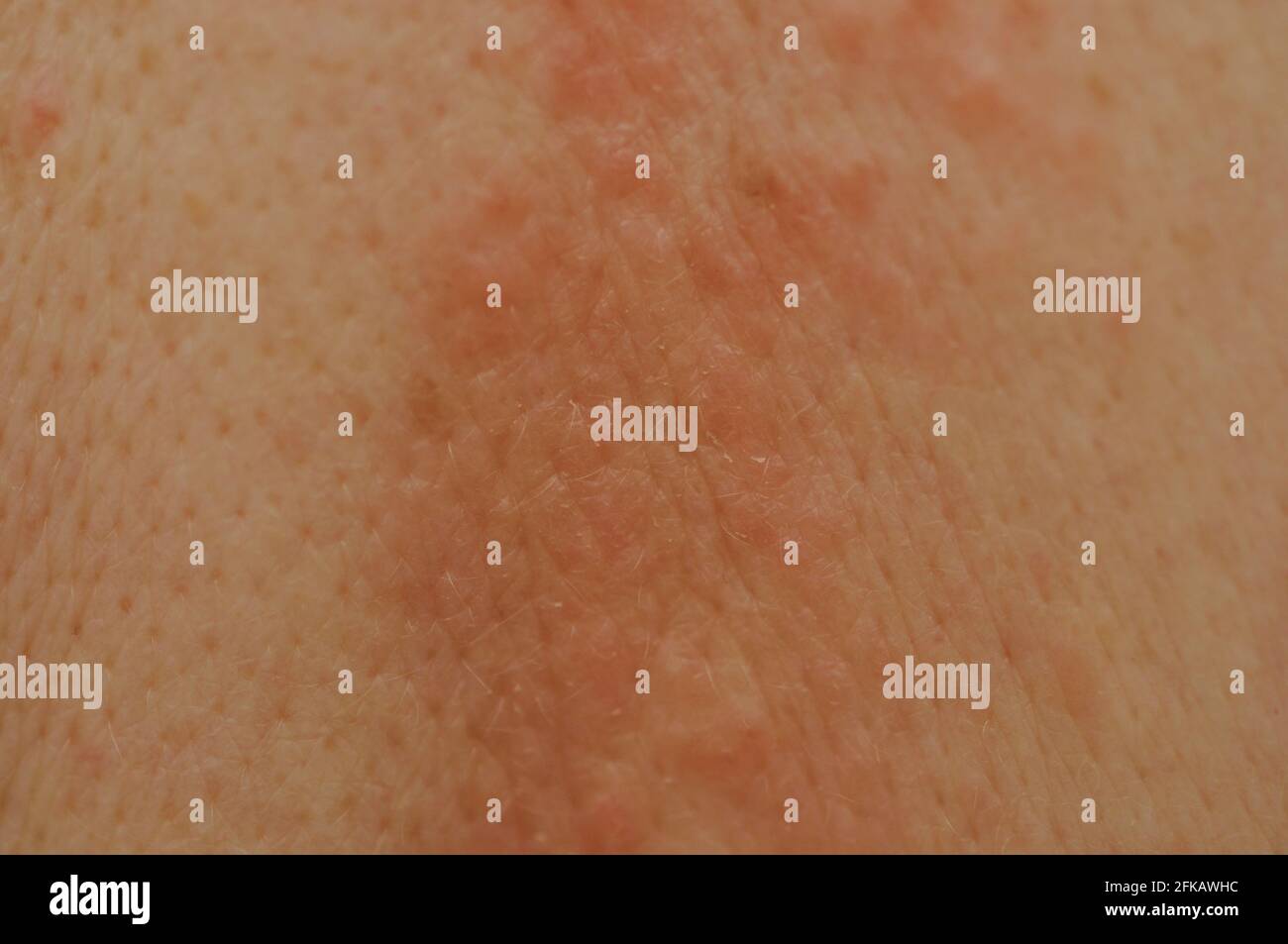 Eczema pimples on a back Stock Photo Alamy