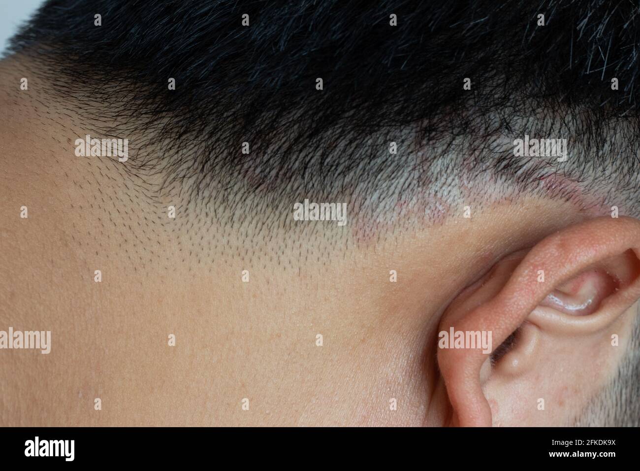 Closed up of ringworm (tinea) on head of asian man (Dermatitis) Stock Photo