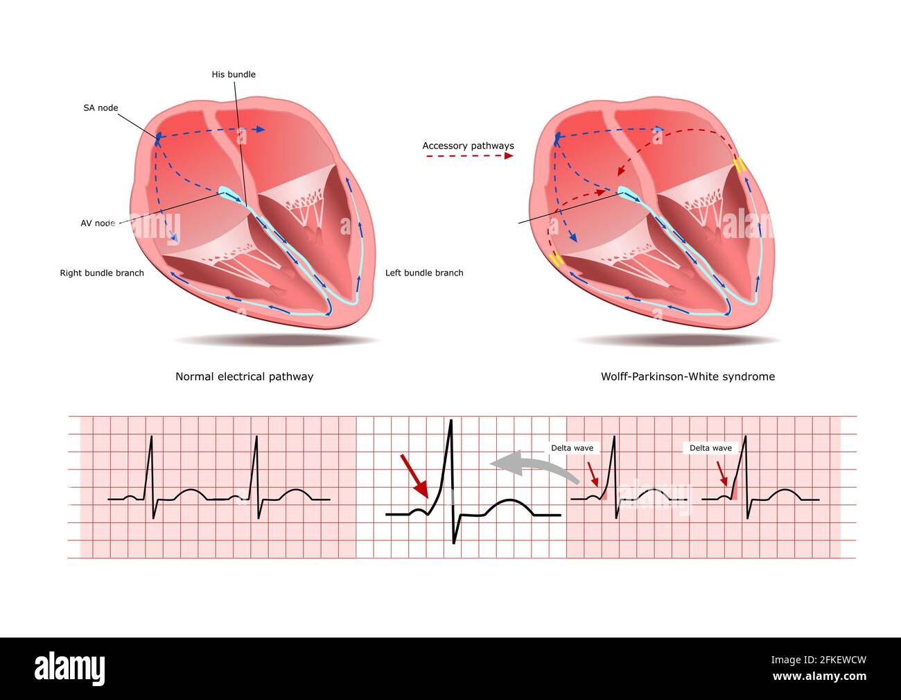 The Walff Parkinson White Wpw Syndrome A Condition With Altered Electrical Signaling A Normal End Altered Electrocariogram Delta Wave Stock Photo Alamy The Walff Parkinson White Wpw Syndrome A Condition With Altered Electrical Signaling A Normal End Altered Electrocariogram Delta Wave Stock Photo Alamy