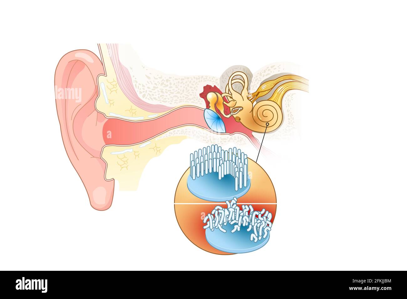 Tinnitus, healthy and damaged hair cells inside cochlea Stock Photo