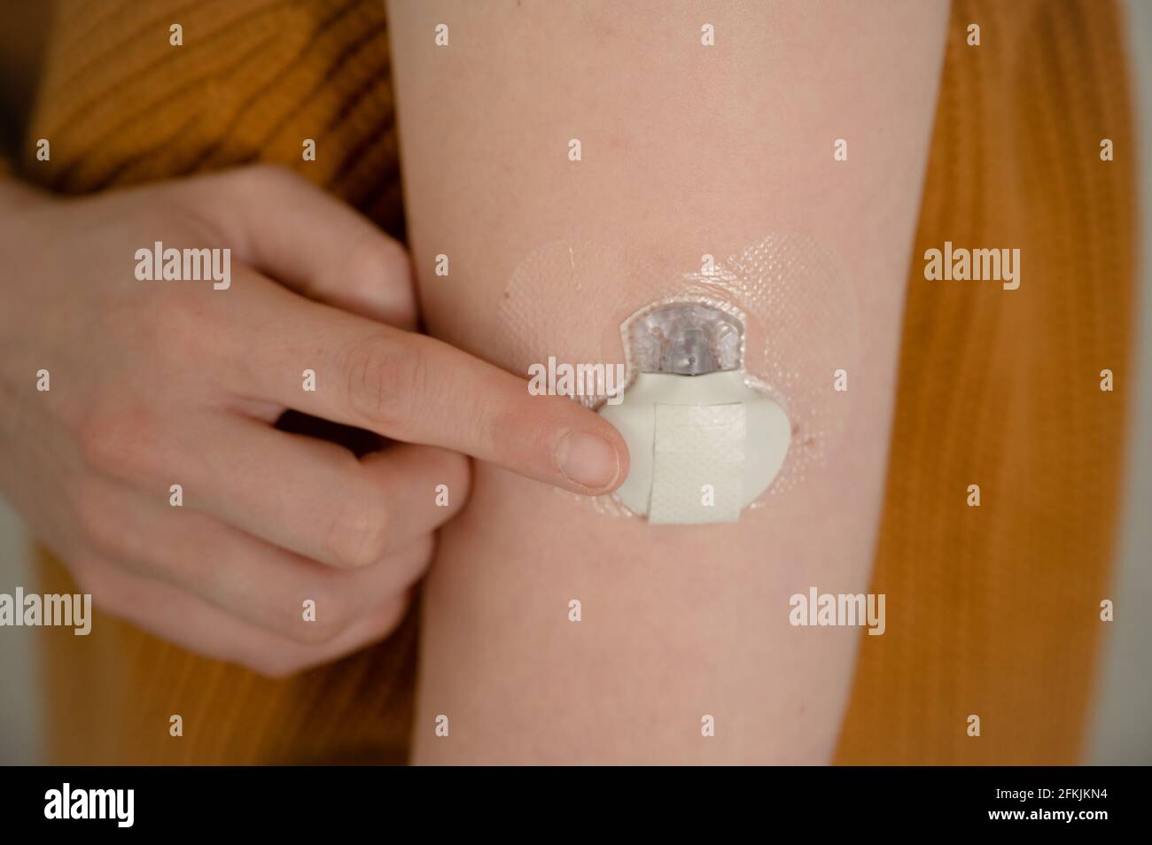 Continuous Glucose monitoring sensor on a diabetes patients arm Stock