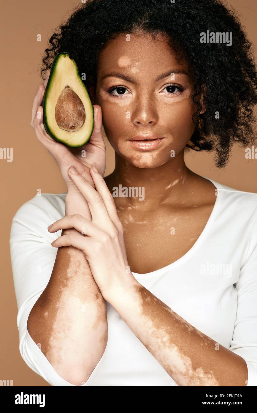 Woman with vitiligo holds avocado on beige background. Moisturize and care for pigmented skin Stock Photo