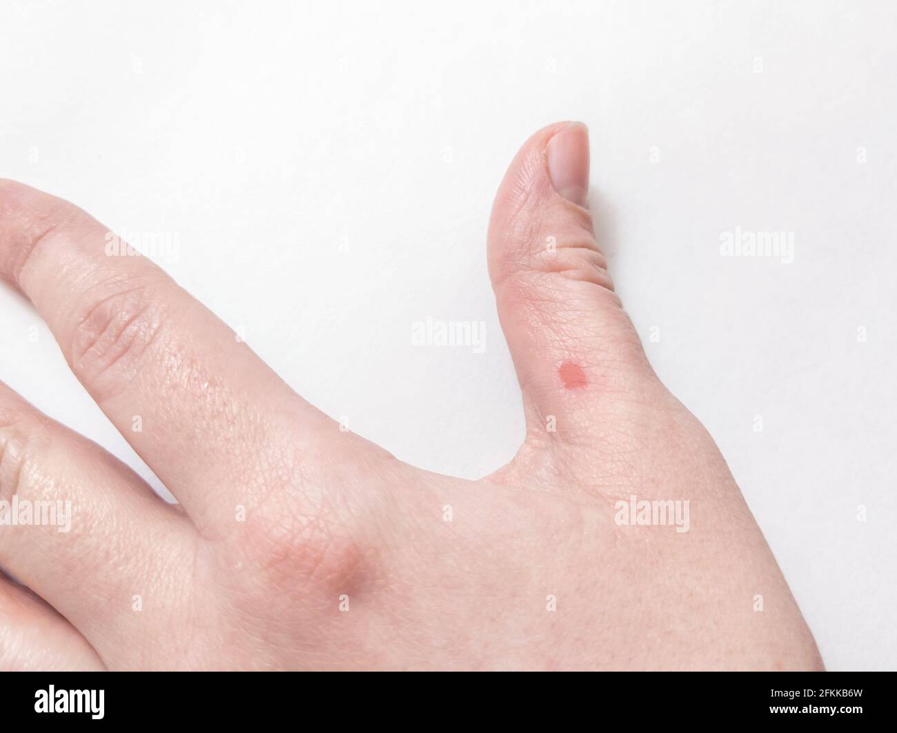 Close up of a popped blister in a Caucasian person's thumb against a white background Stock Photo