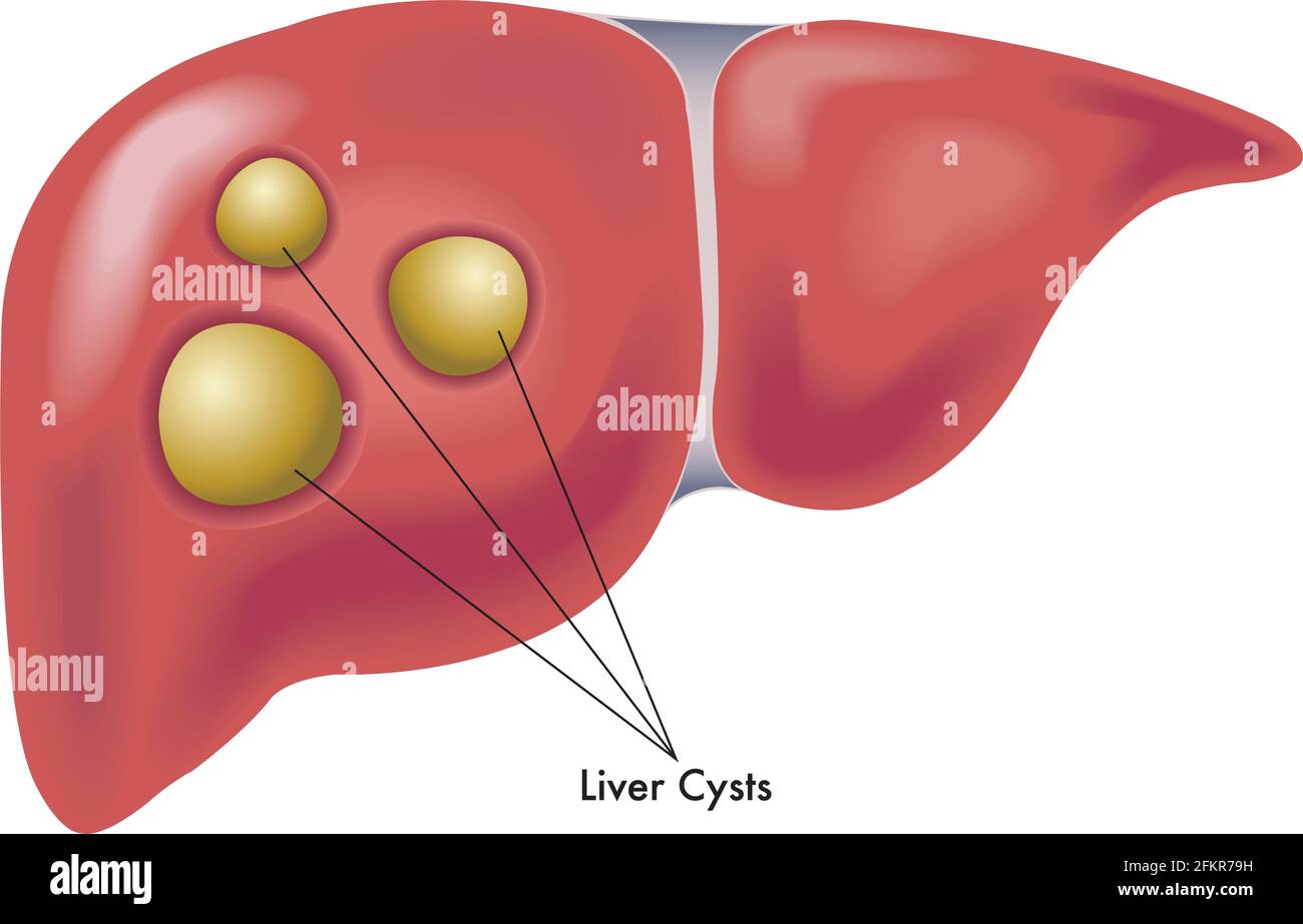 Medical illustration shows a liver with various cysts. Stock Vector