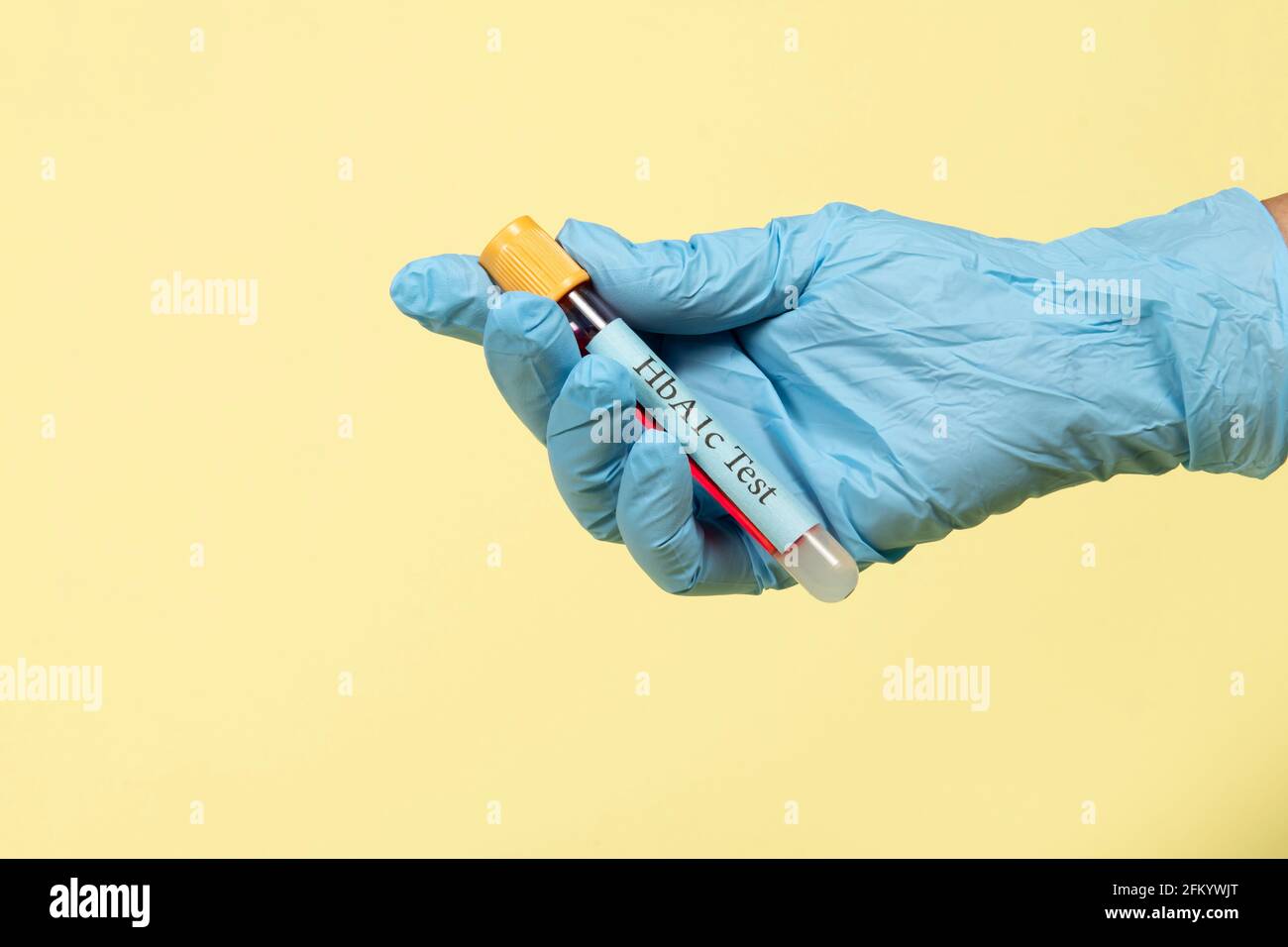 Blood sample in a vacuum tube for hemoglobin HbA1c test diabetes