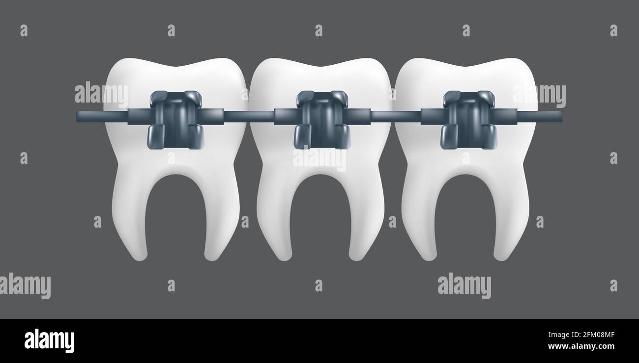 Teeth with metal braces. Orthodontic treatment concept. 3d realistic
