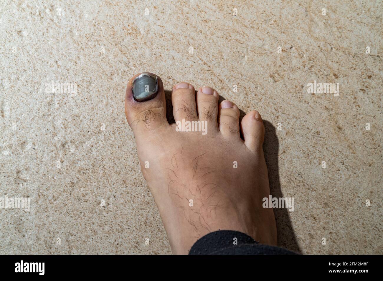 Foot with loose first toenail about to fall off, purple in color and