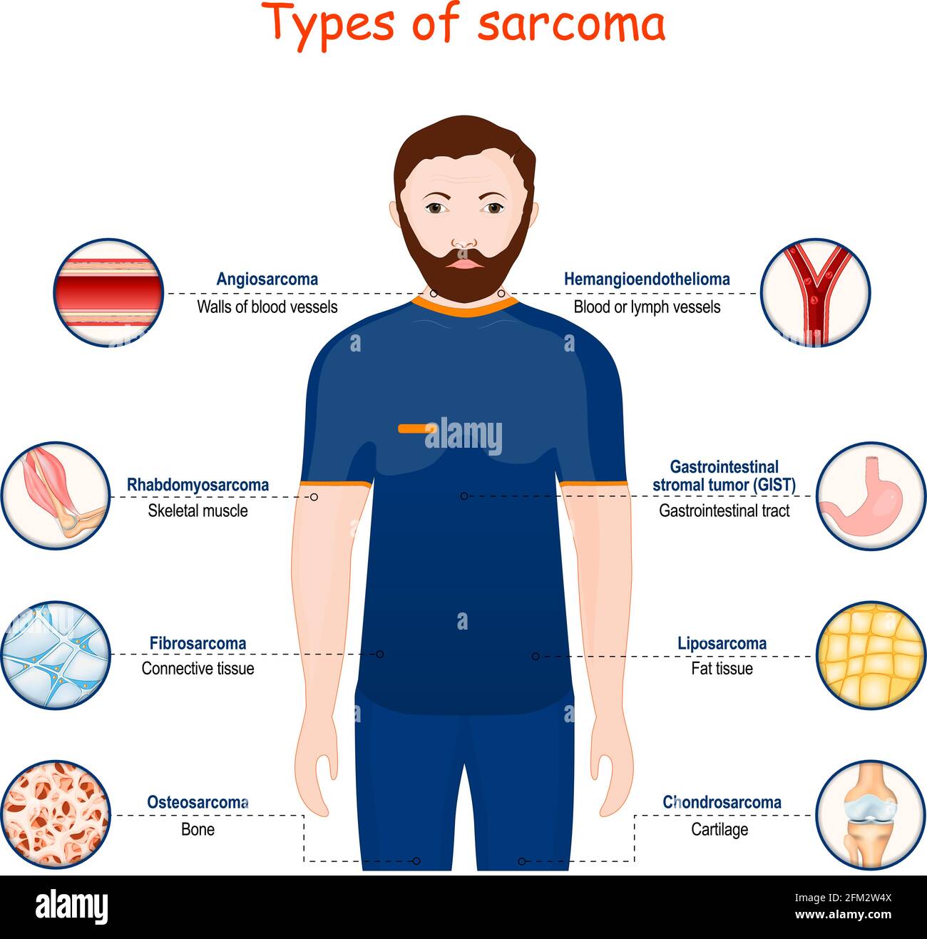 sarcoma. Types of a malignant tumor. cancer that arises from transformed cells of connective, bone, cartilage, fat, and vascular tissue. Vector Stock Vector