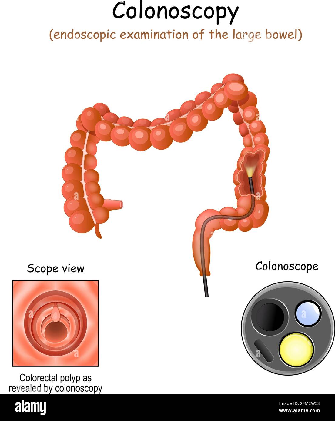 colonoscopy in the large bowel. Close-up of colonoscope, and Colorectal polyp. Cross section of a colon. Vector illustration Stock Vector