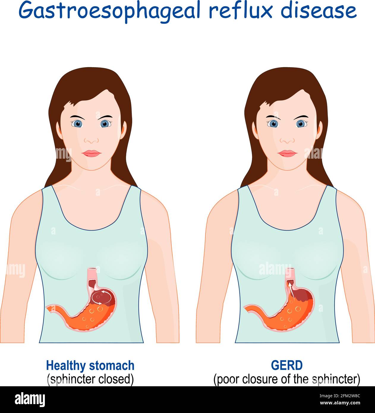 Heartburn gastric and Gastroesophageal Reflux Disease. Woman with healthy stomach, and GERD (poor closure of the sphincter Stock Vector