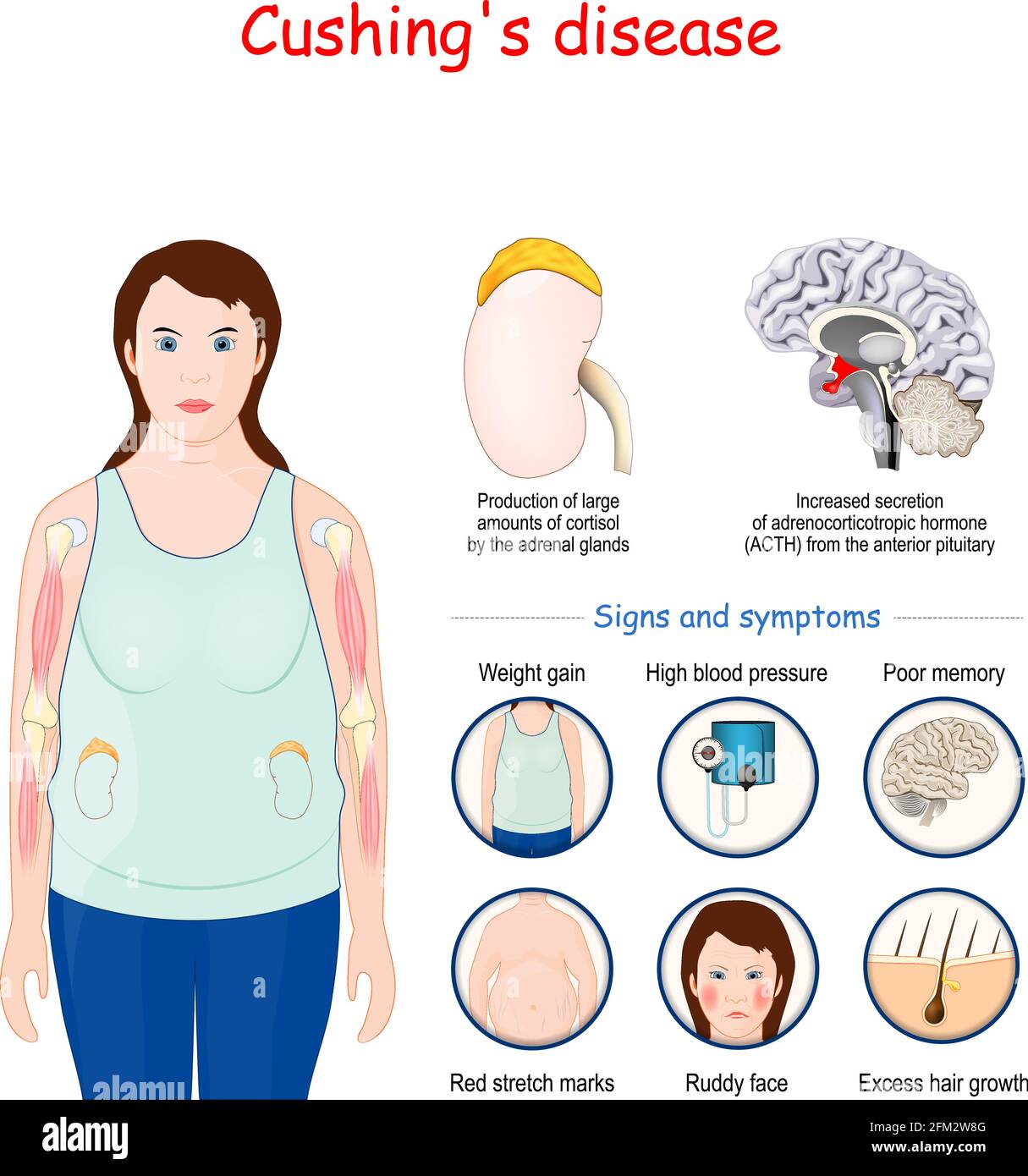 Cushing's disease. Signs and symptoms of Cushing syndrome. Vector illustration Stock Vector