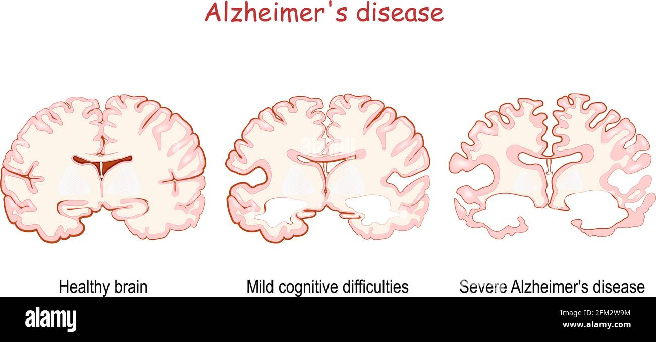 Alzheimer's, is a neurodegenerative disease. dementia. comparison and difference between Healthy brain, Severe Alzheimer's disease, and Mild cognitive Stock Vector
