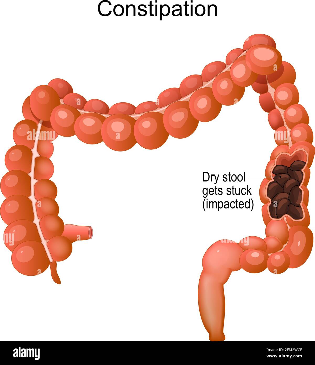 Constipation. Dry stool gets stuck (impacted) in large intestine. Vector illustration Stock Vector