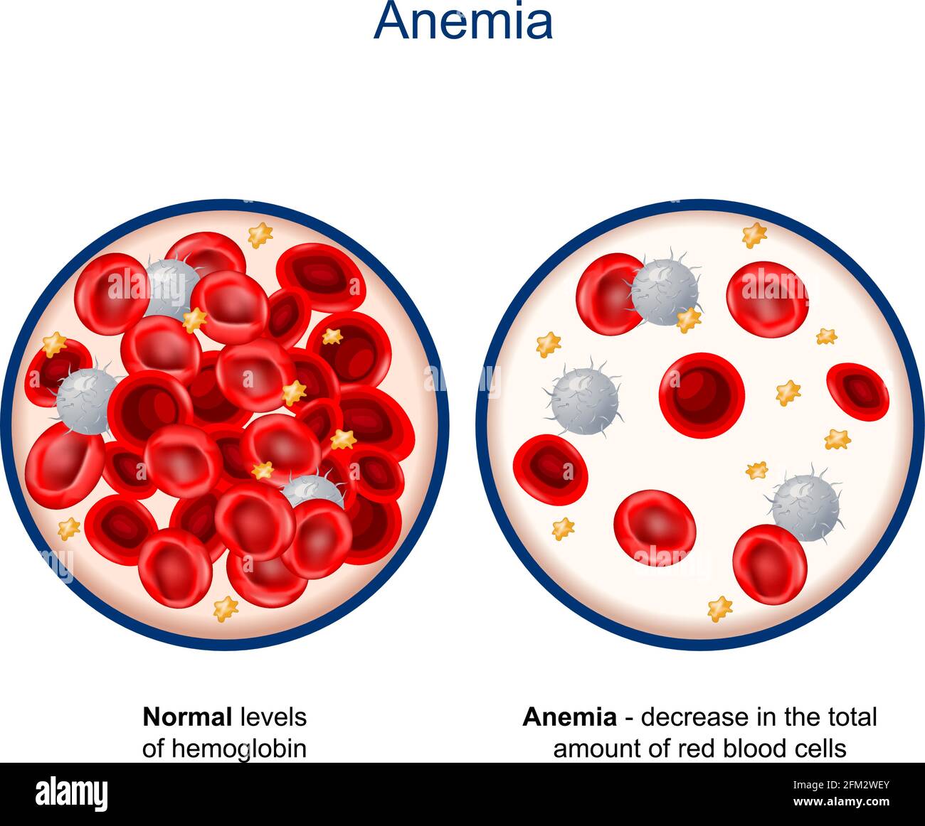Anemia. comparison and difference between Normal levels of hemoglobin and decrease in the total amount of red blood cells. Close-up Stock Vector
