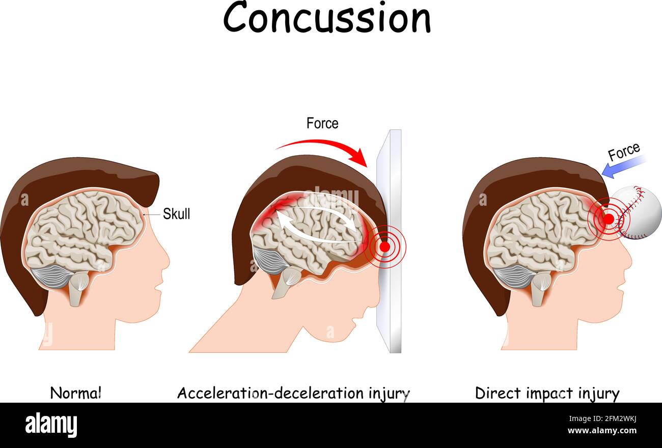 concussion in sport. mild traumatic brain injury (mTBI). Concussions that caused by a direct blow of a baseball, and by indirect trauma to the head Stock Vector