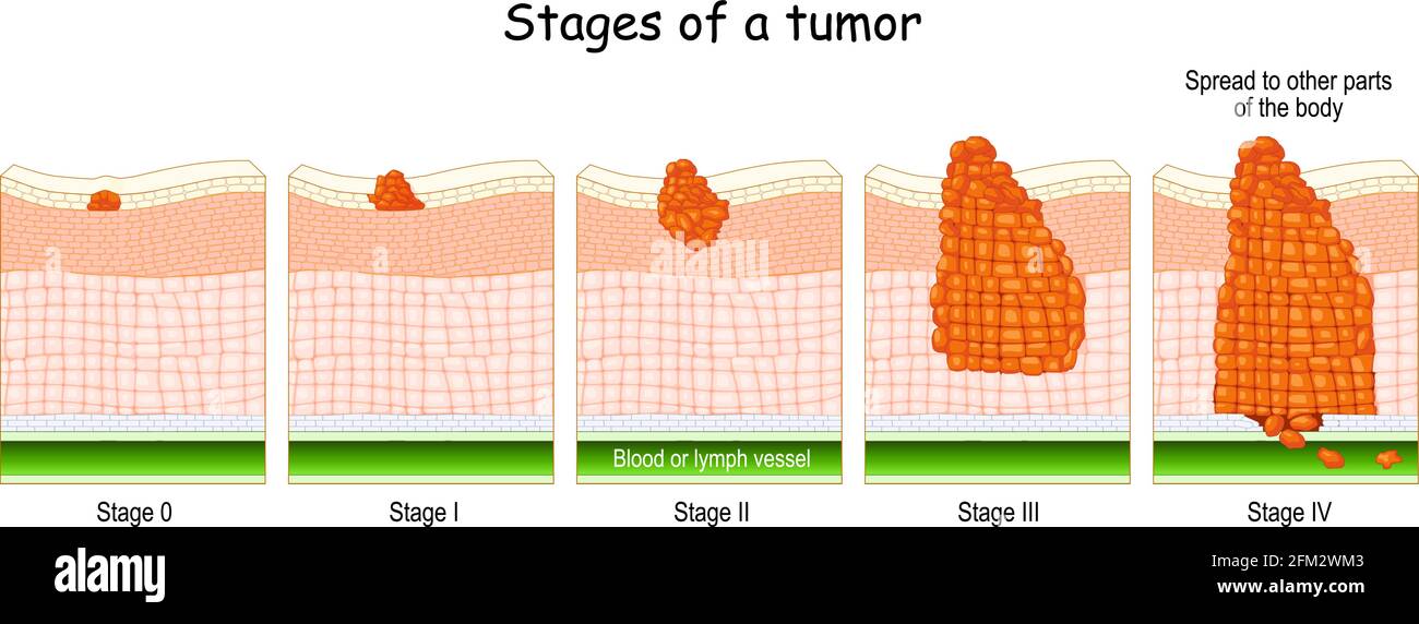 stages of cancer. Classification of Malignant Tumors (from 0 to 4). system that is most commonly used for the staging process of cancer Stock Vector