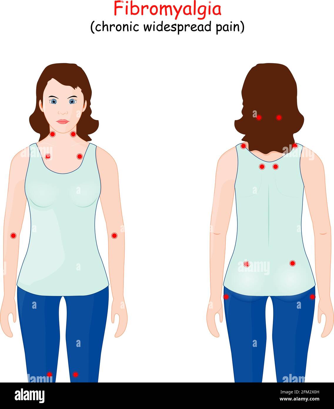 fibromyalgia tender point map. Rheumatology. woman with location of the nine paired tender points of chronic widespread pain. Stock Vector