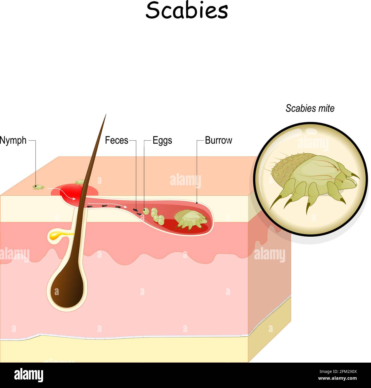 Scabies. seven-year itch is a contagious skin infestation by the mite Sarcoptes scabiei. Skin with eggs and mite in a burrow. Close-up of Scabies mite Stock Vector