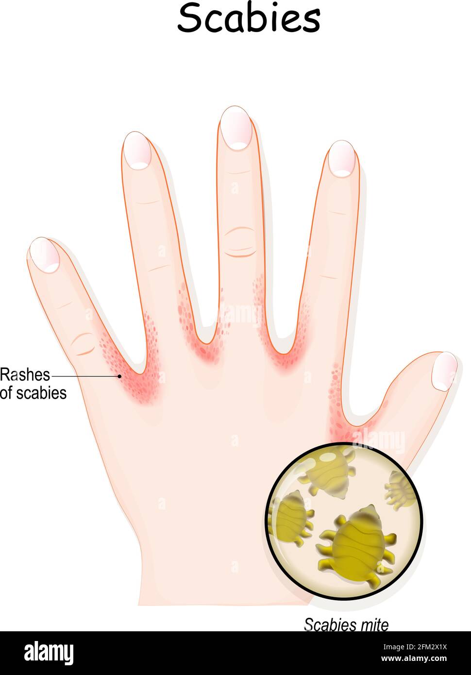 https://c8.alamy.com/comp/2FM2X1X/scabies-mite-humans-hand-skin-with-rashes-seven-year-itch-is-a-contagious-skin-infestation-by-the-mite-sarcoptes-scabiei-close-up-of-scabies-mite-2FM2X1X.jpg