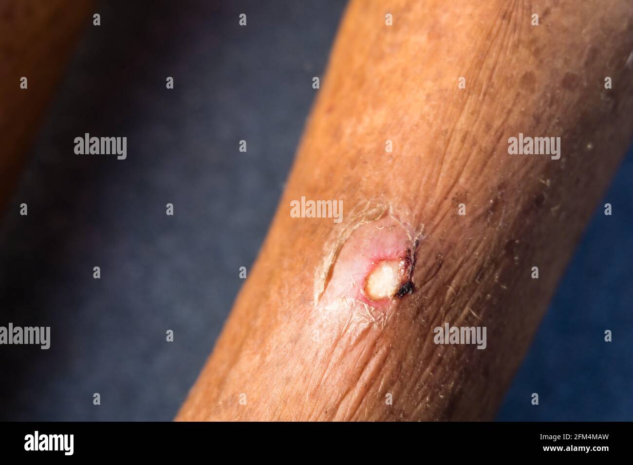 Boil skin hi-res stock photography and images - Alamy