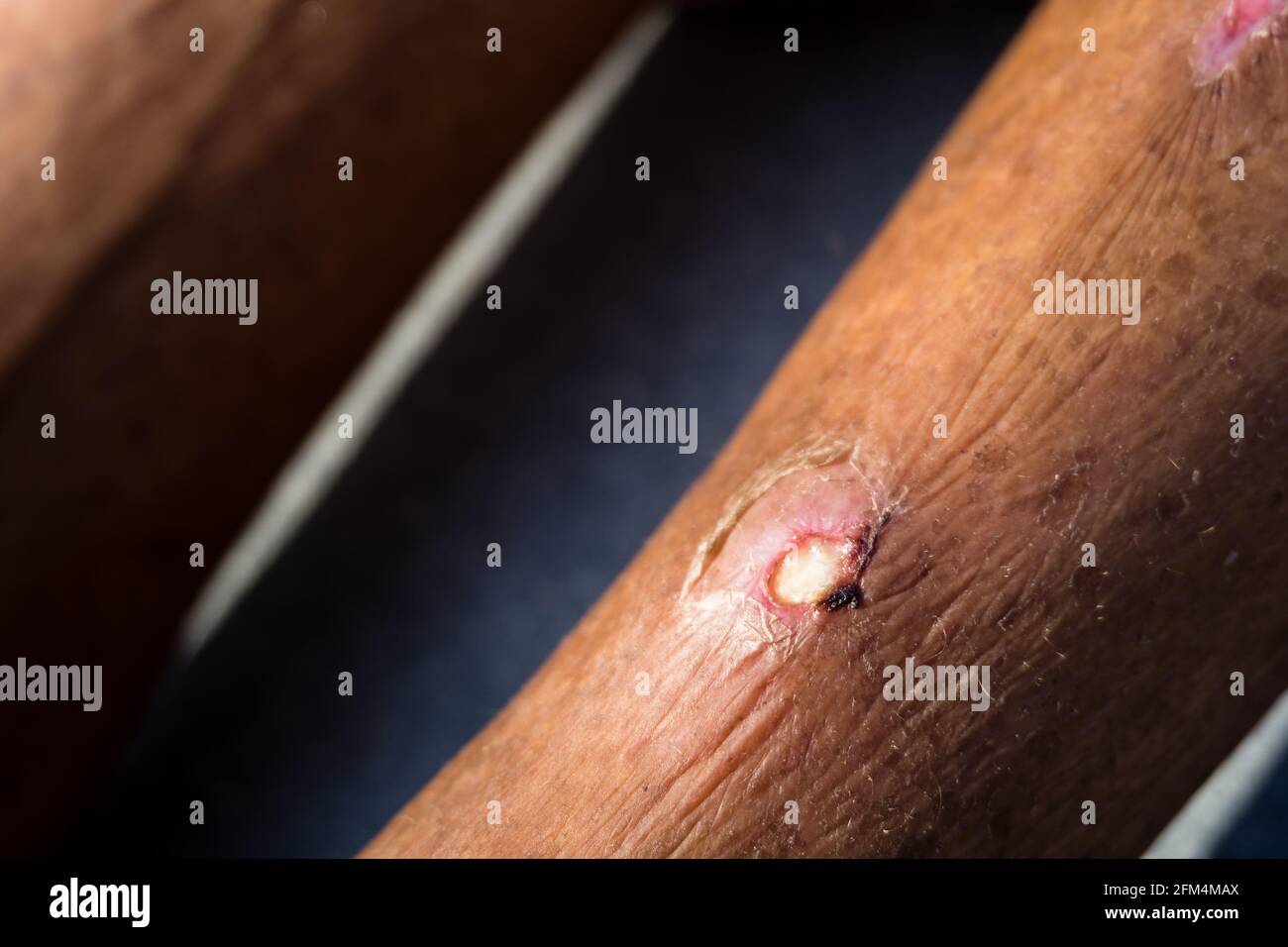 A close up shot of an infected boil filled with pus inside on the leg of a patient. A painful, pus-filled bump under the skin caused by infected, infl Stock Photo