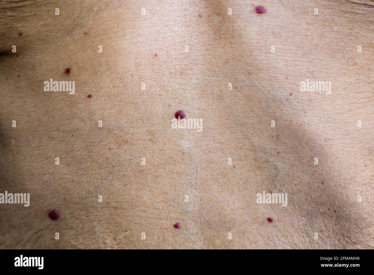 Skin Angiomas Hi Res Stock Photography And Images Alamy