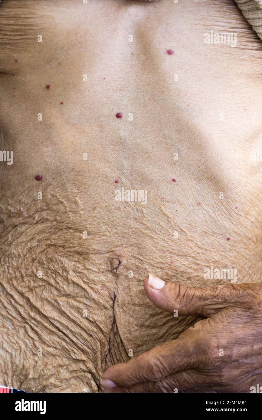 A close up shot of wrinkles on belly skin due to old age, Skin folds on an elderly female body. Stock Photo