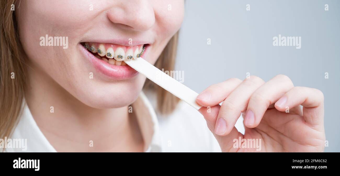 Young woman with metal braces on her teeth is chewing gum. The girl is eating gummy candy Stock