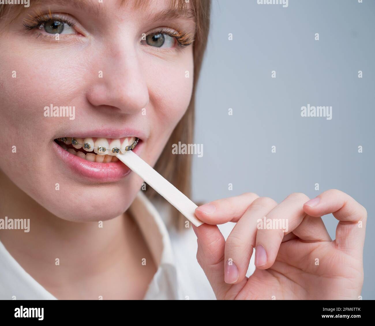 Young woman with metal braces on her teeth is chewing gum. The girl is eating gummy candy Stock