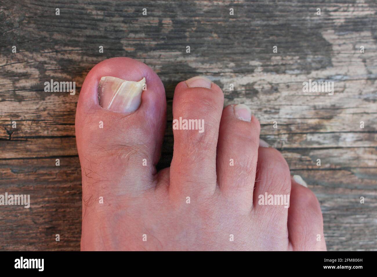 Damaged toenail. Top view Stock Photo Alamy