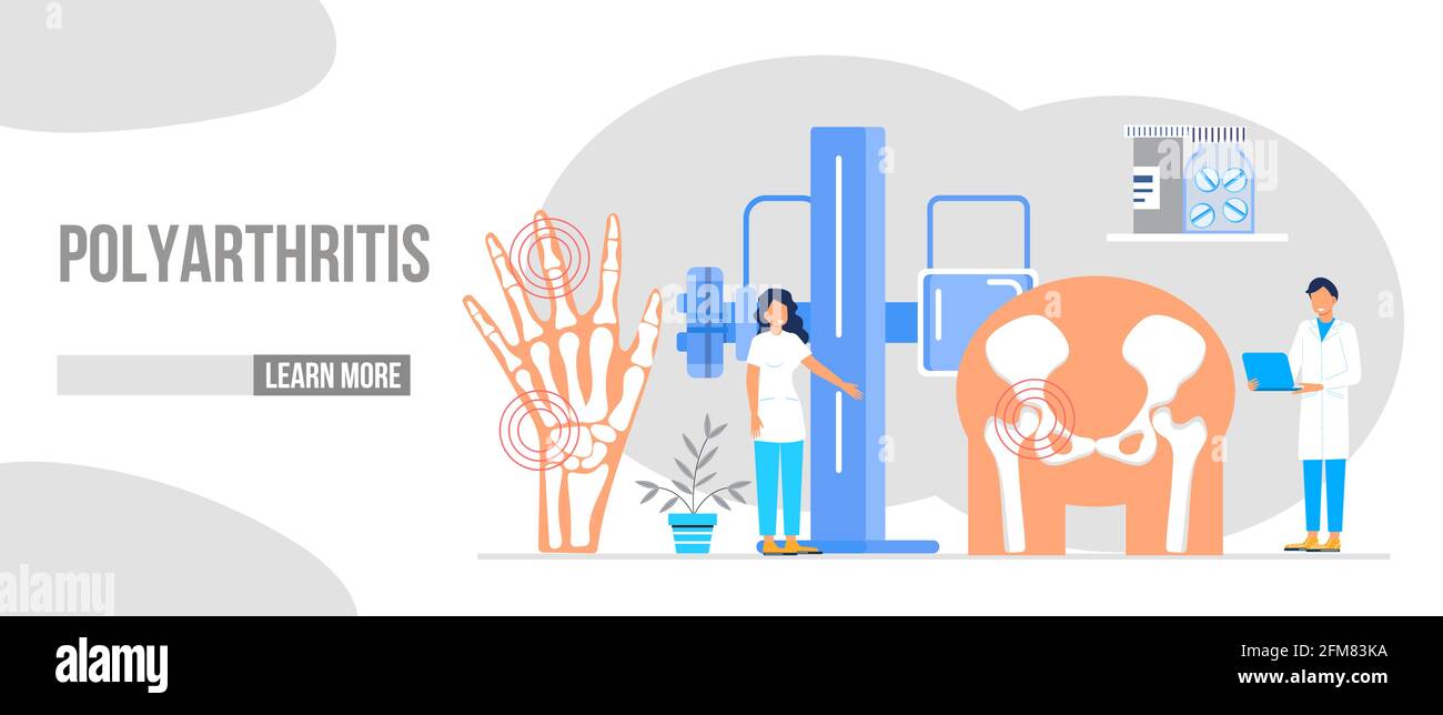 Rheumatoid arthritis of the foot. Tiny doctors treat rheumatism