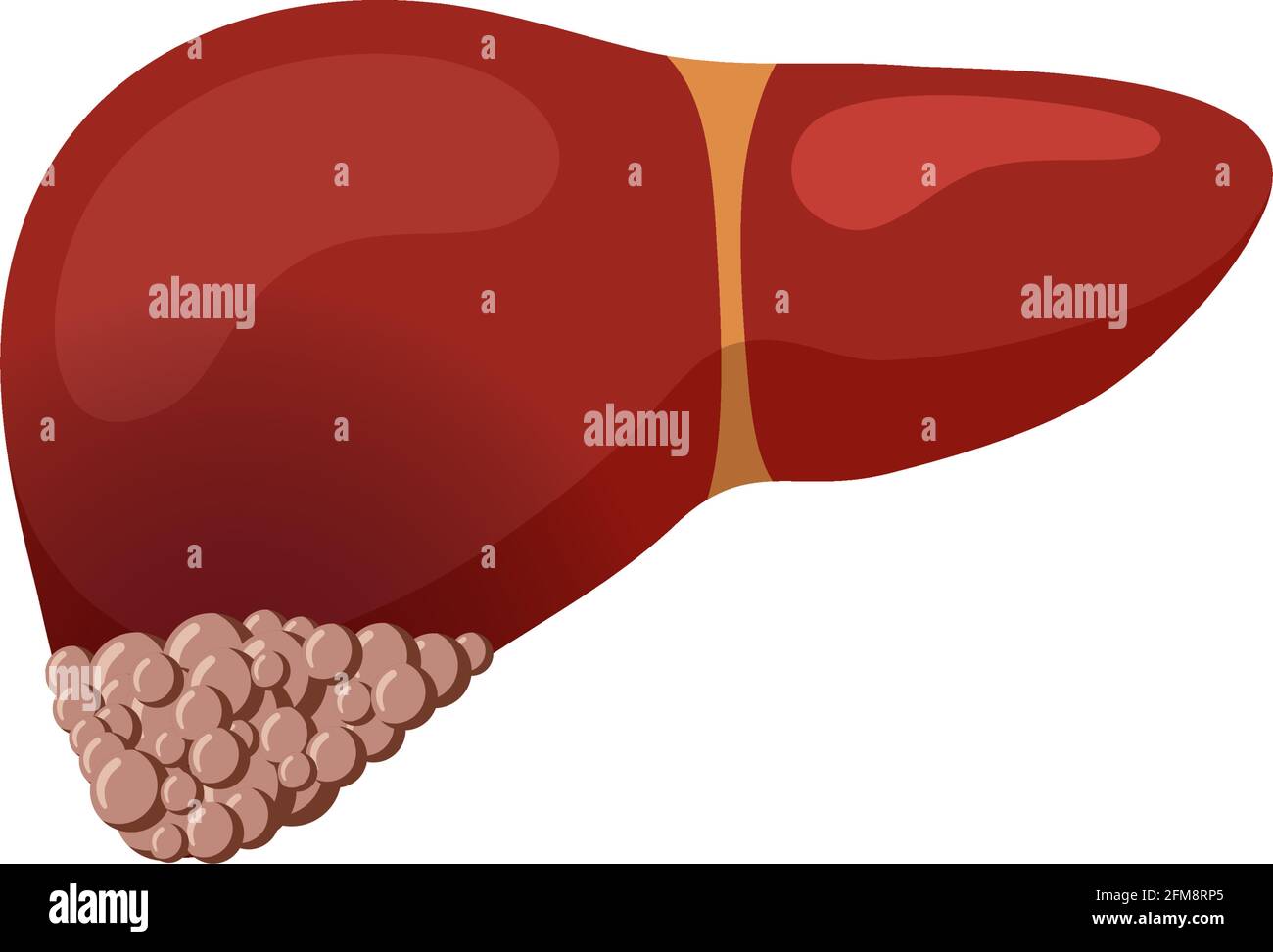 Unhealthy liver cancer. Human exocrine gland organ tumor destruction concept. Vector oncology flat illustration Stock Vector