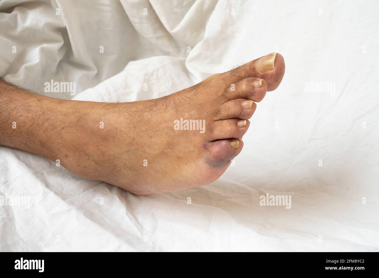 Bruising little foot toe. Close up on the broken little toe of a senior man showing discoloration. Stock Photo