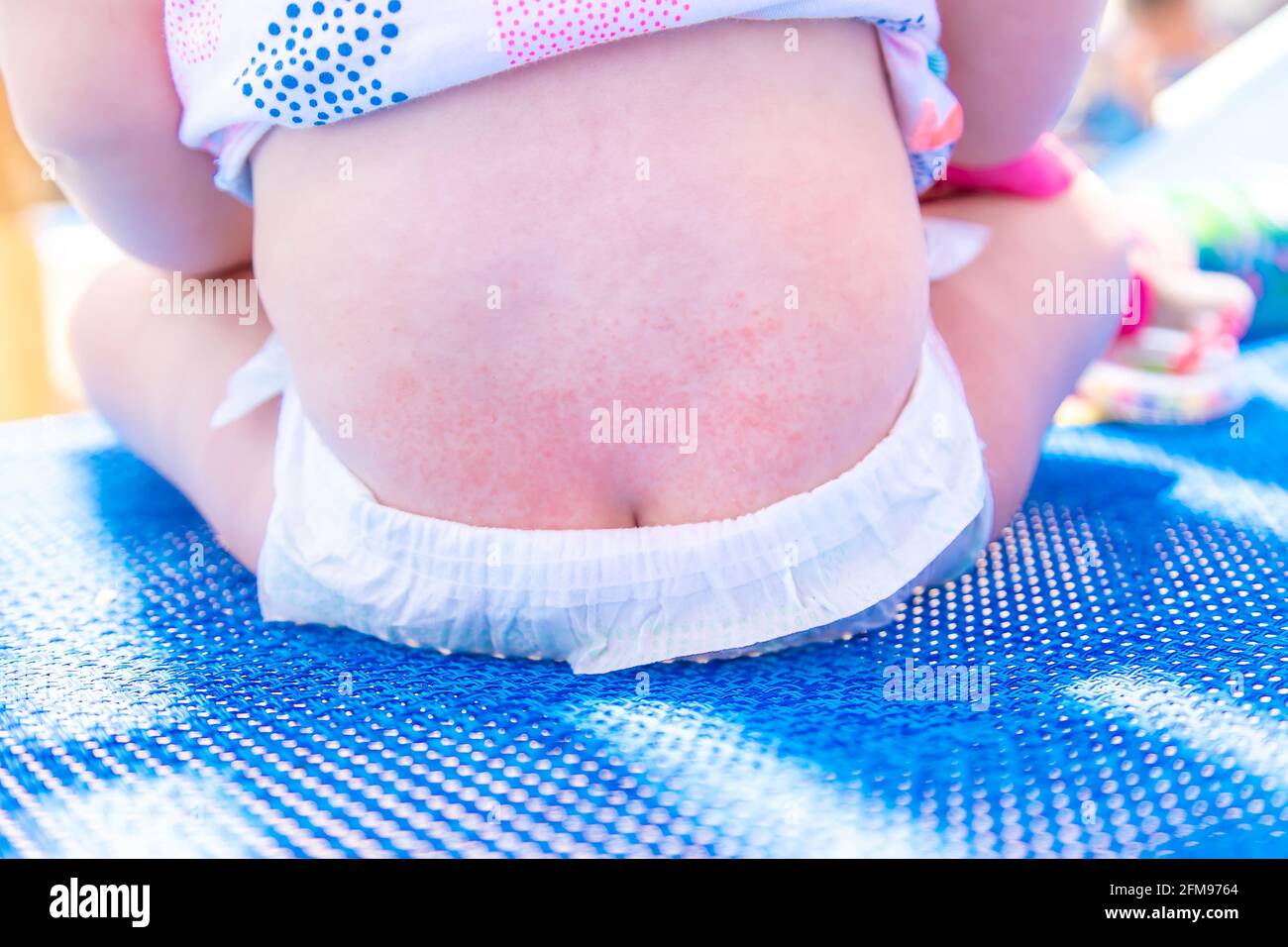 Baby's back rash is allergic. Selective focus. Child Stock Photo - Alamy