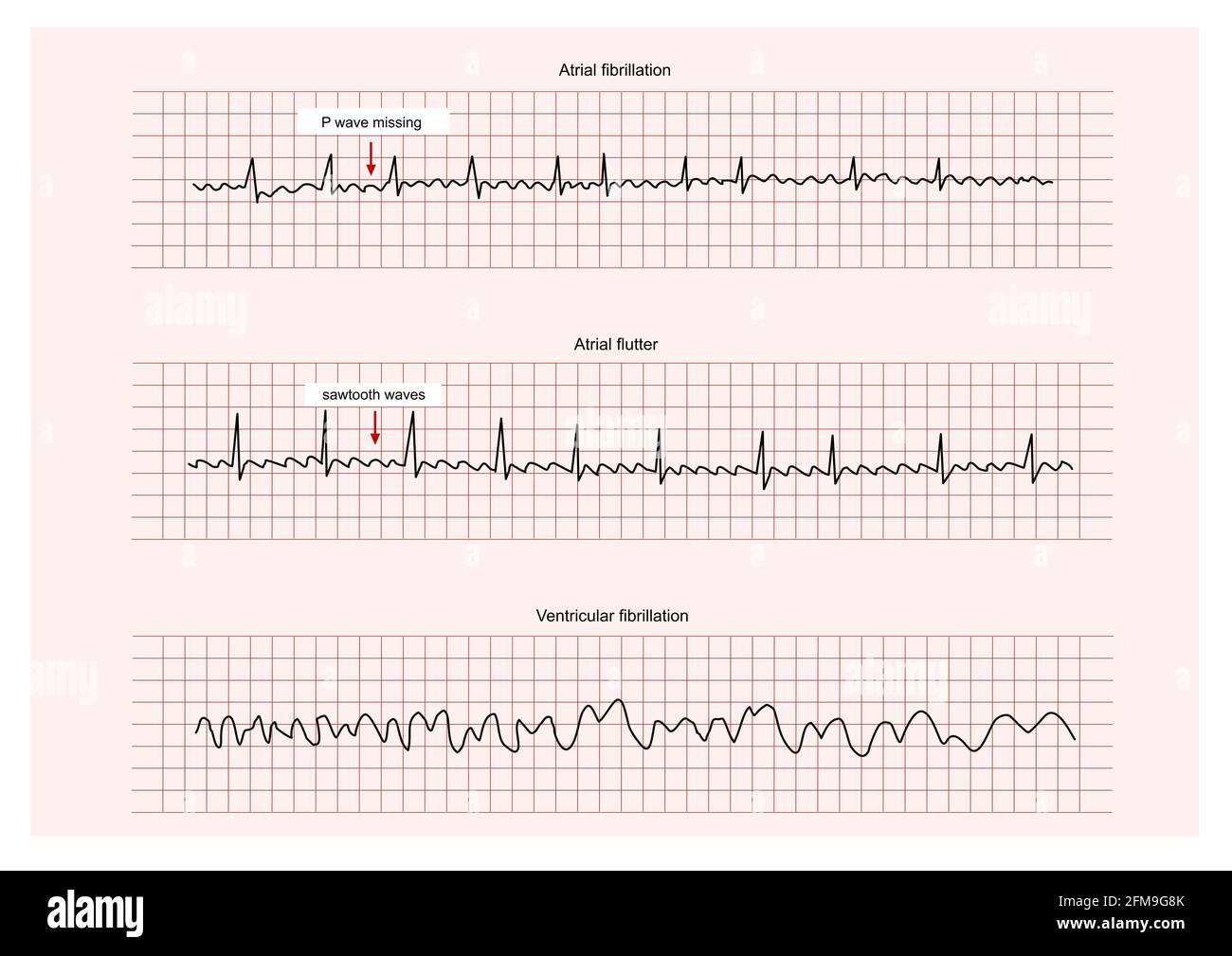 Atrial fibrillation ecg hi-res stock photography and images - Alamy