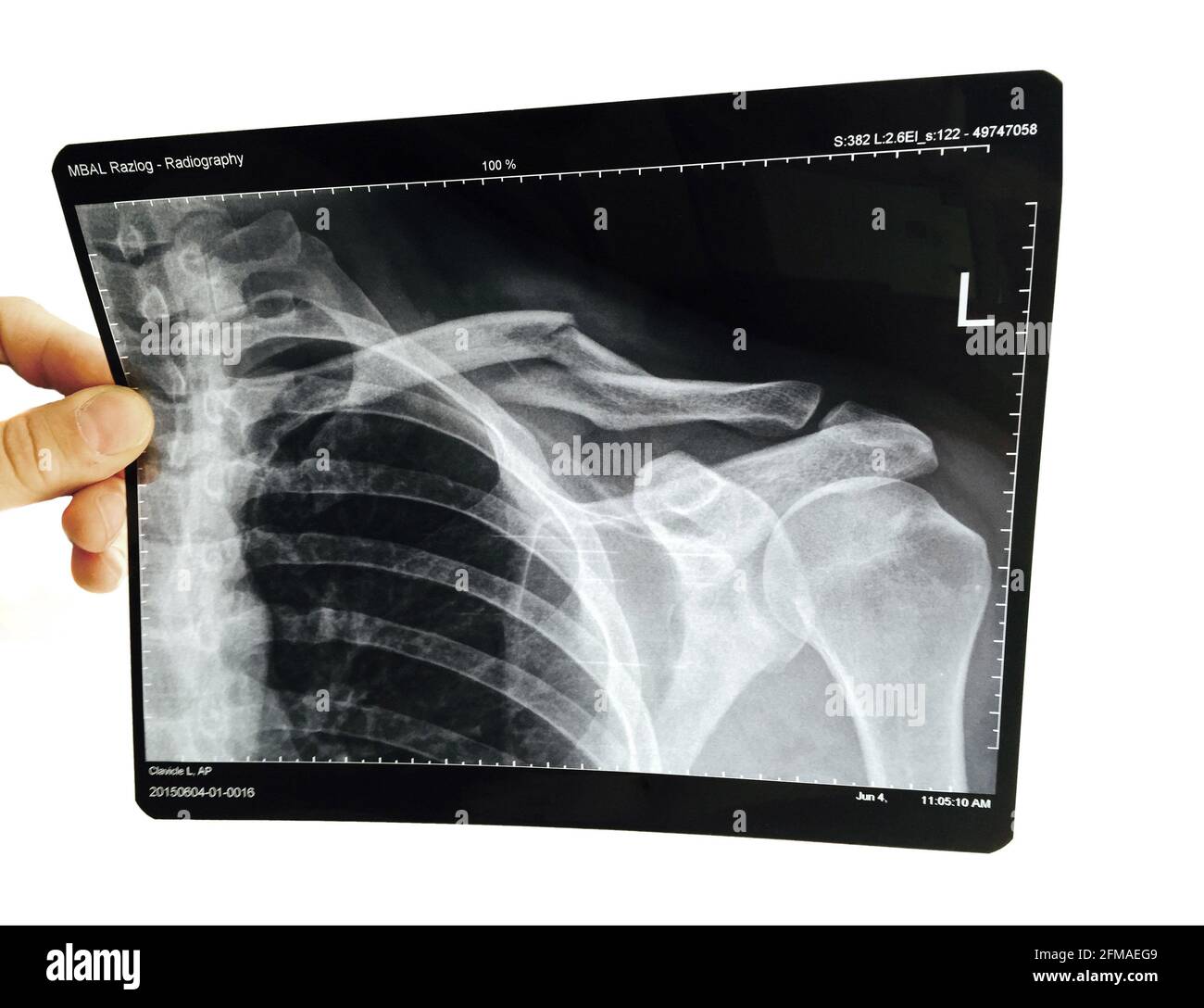 Broken left collarbone. Clavicle fracture. Hospital Xray. model & property released. Stock Photo