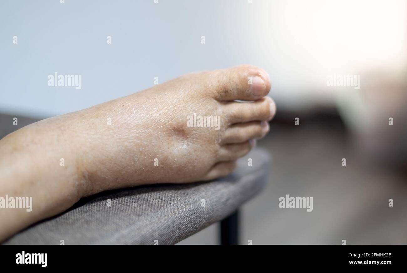 Swollen fingers hires stock photography and images Alamy