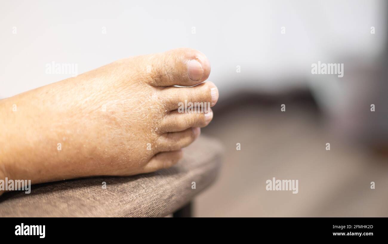 Swollen Feet High Resolution Stock Photography and Images Alamy