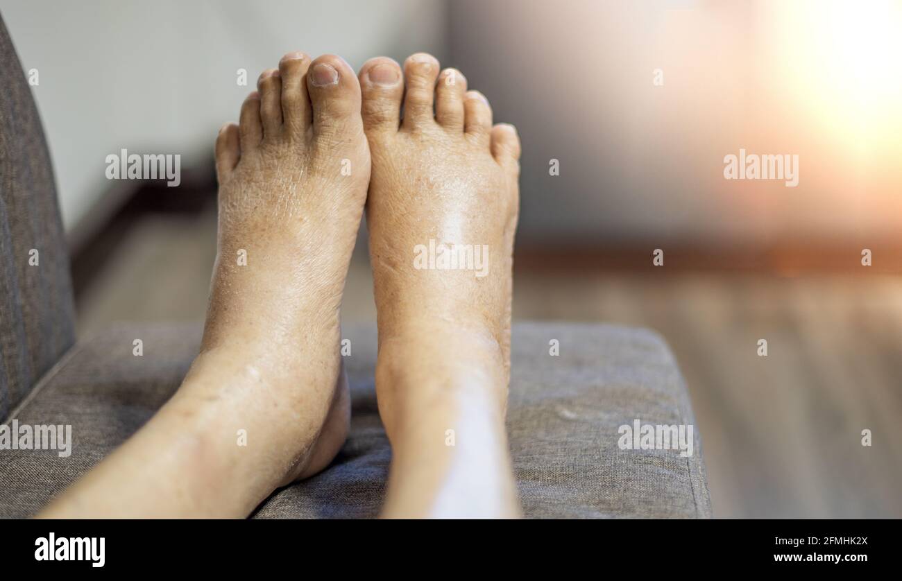 The feet of old man wrinkle skin swollen feet with the cancer and the body  lack of the protein for health so not good Stock Photo - Alamy