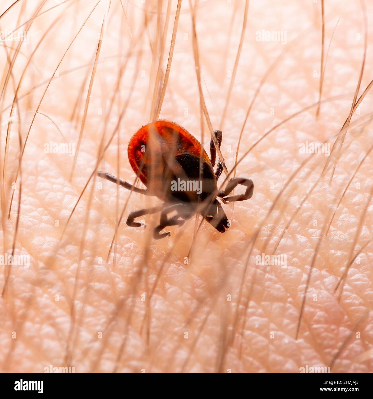 Infectious Encephalitis Ixodes Scapularis or Persulcatus Deer Tick
