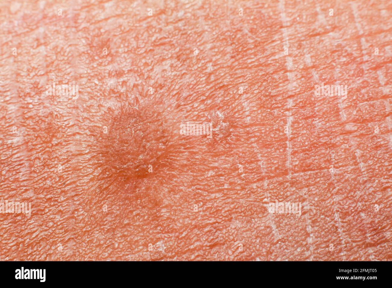 human skin texture. Flat wart on skin micro photo. close up photo. Stock Photo