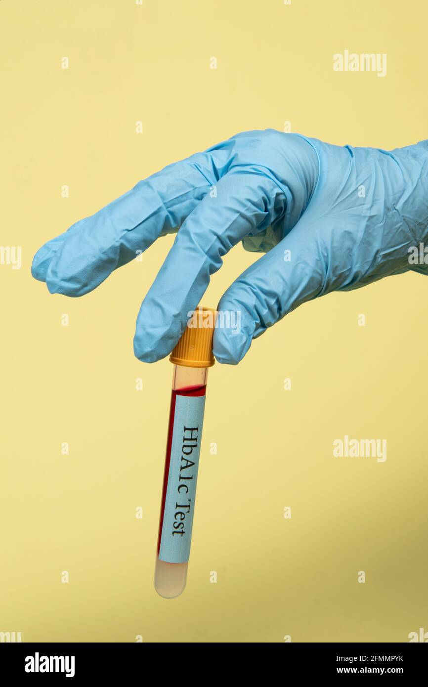 Blood sample in a vacuum tube for hemoglobin HbA1c test diabetes