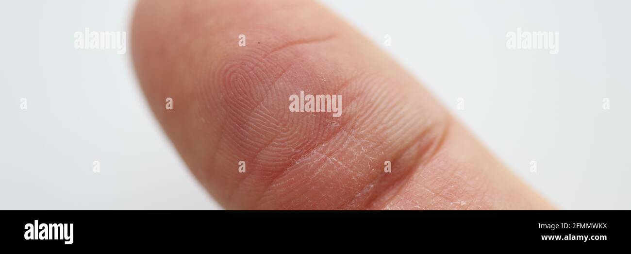Callus finger hires stock photography and images Alamy